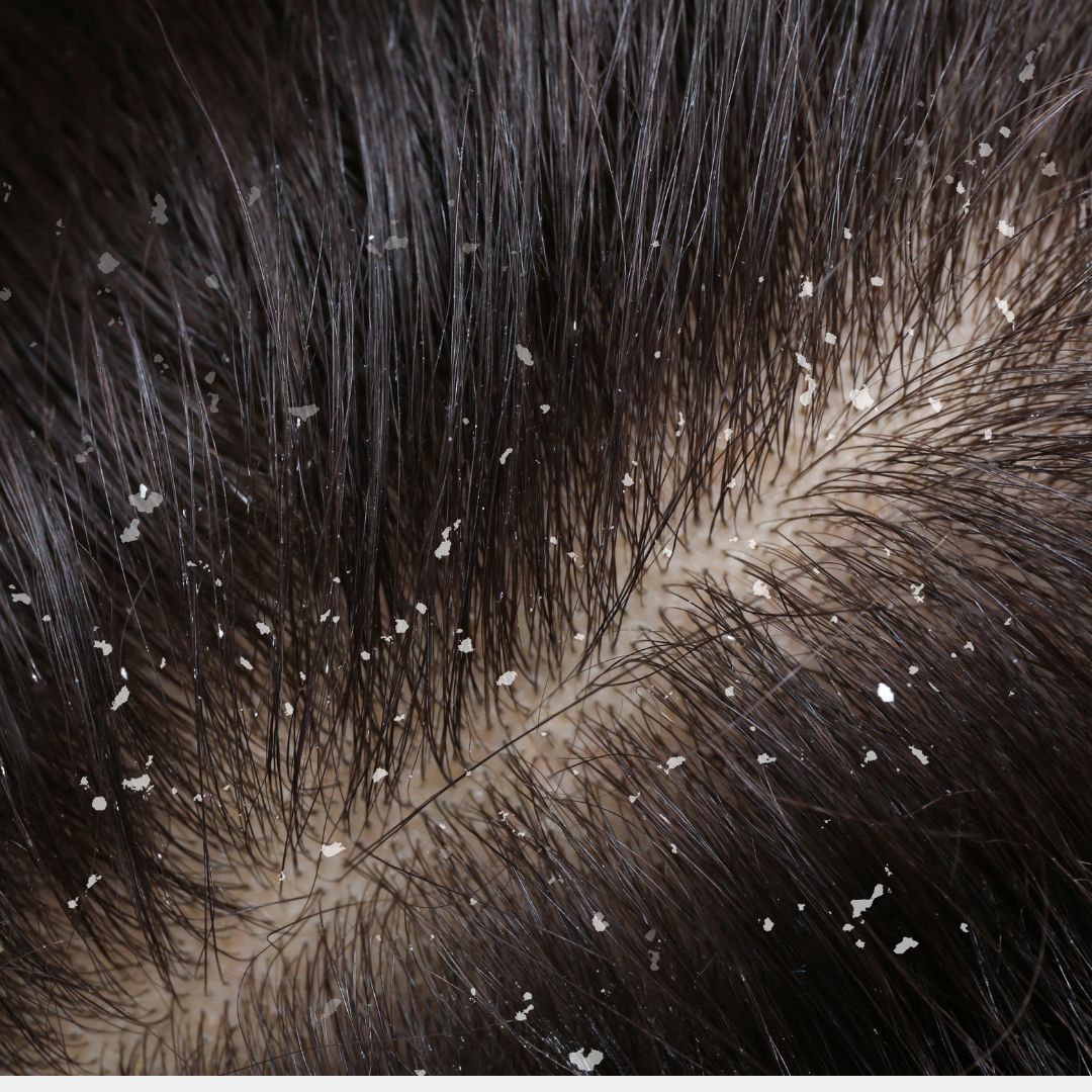 Kopfhaut Schwarze Haare mit Schuppen